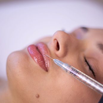 Контурна пластика губ — ін’єкція гіалуронової кислоти для корекції форми губ