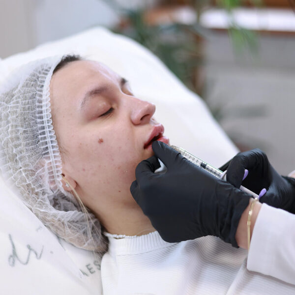 Збільшення губ до і після — процес ін’єкції гіалуронової кислоти в губи